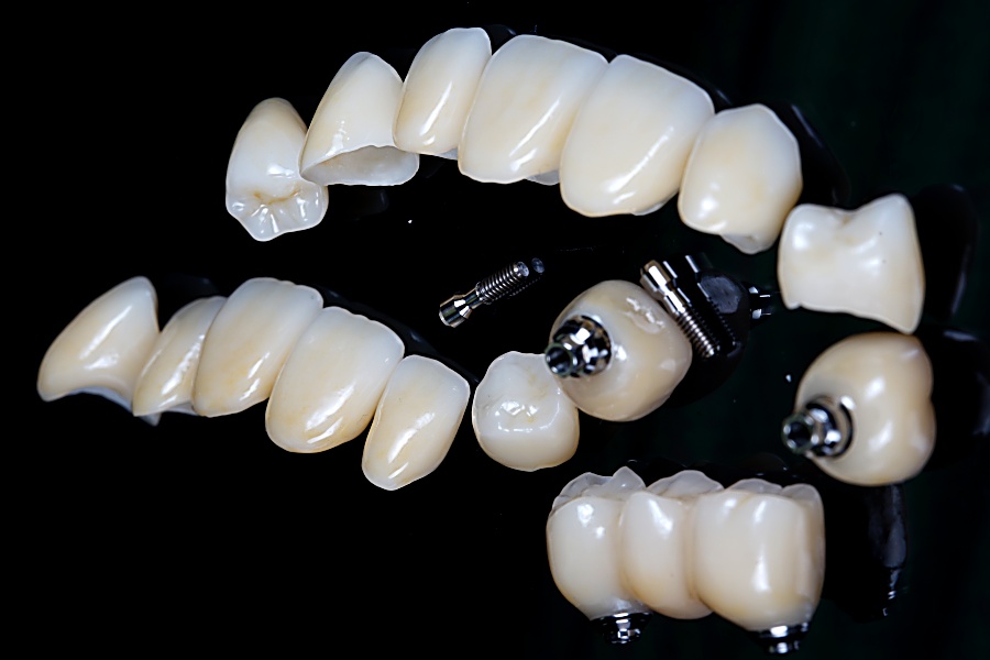 Зубні коронки. Види, особливості