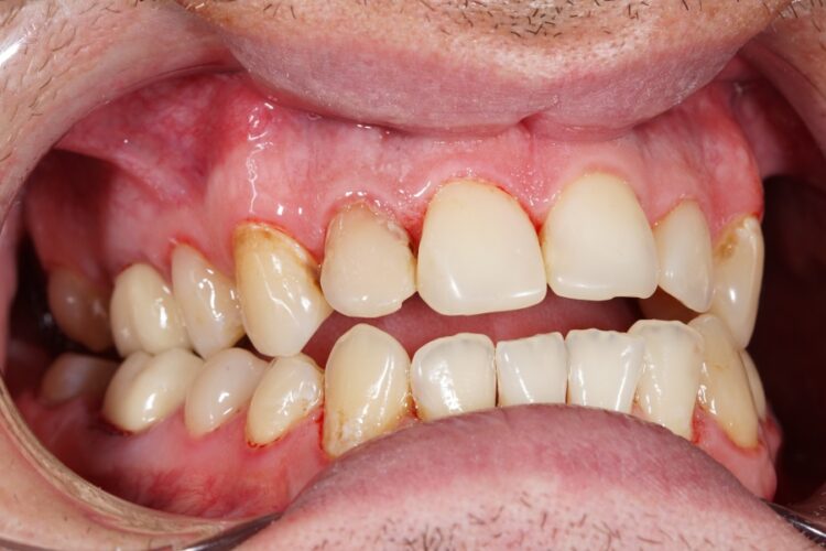 Dental crowns. Types, features