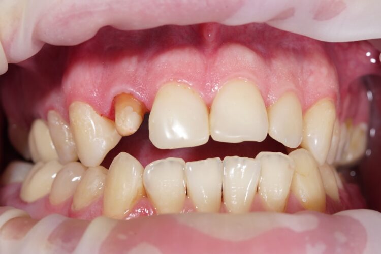 Dental crowns. Types, features