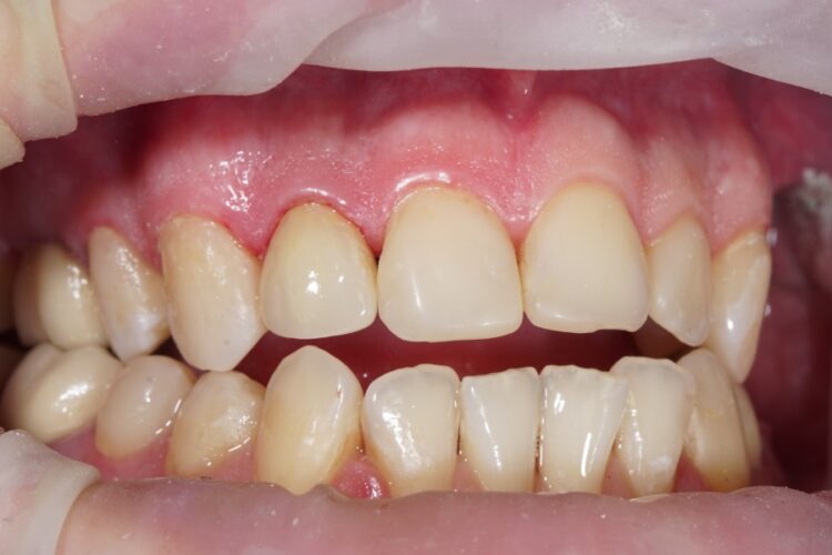 Dental crowns. Types, features