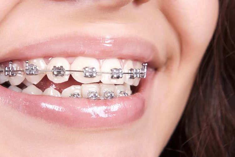 Orthodontic treatment