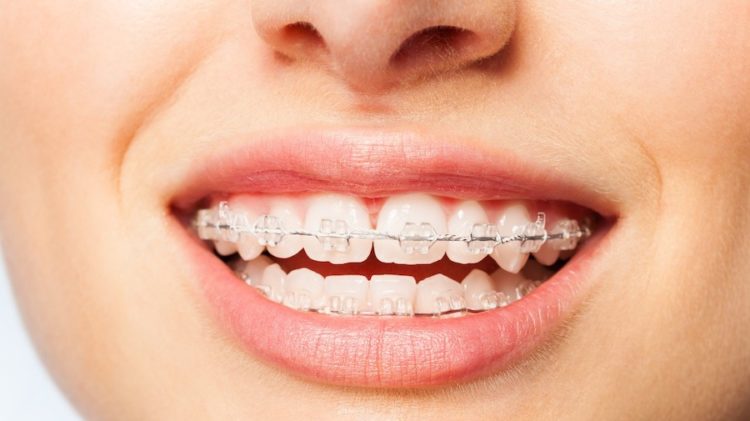 Adult tooth alignment
