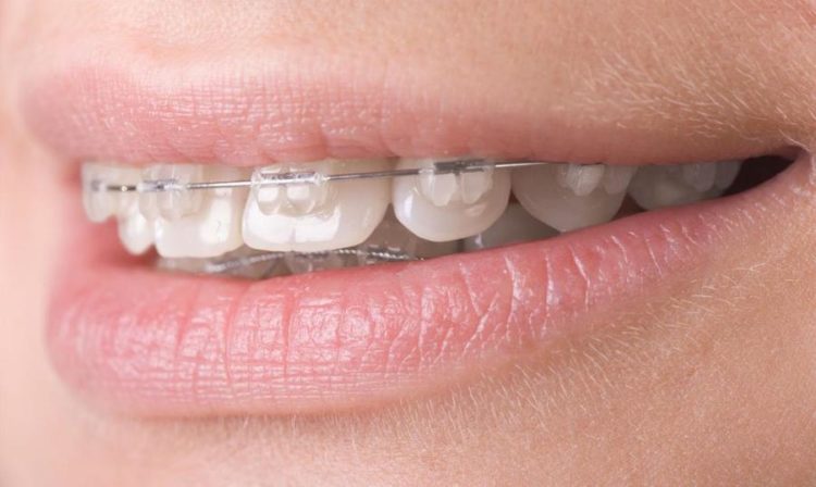 Adult tooth alignment