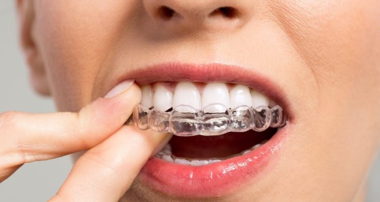 Adult tooth alignment