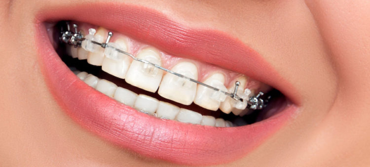 Adult tooth alignment