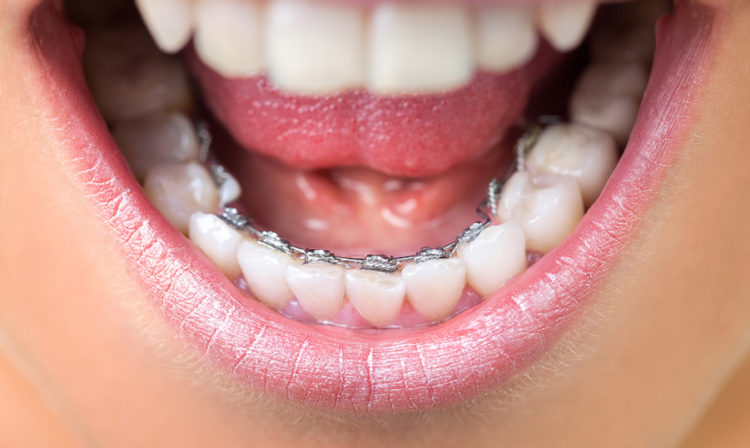 Adult tooth alignment