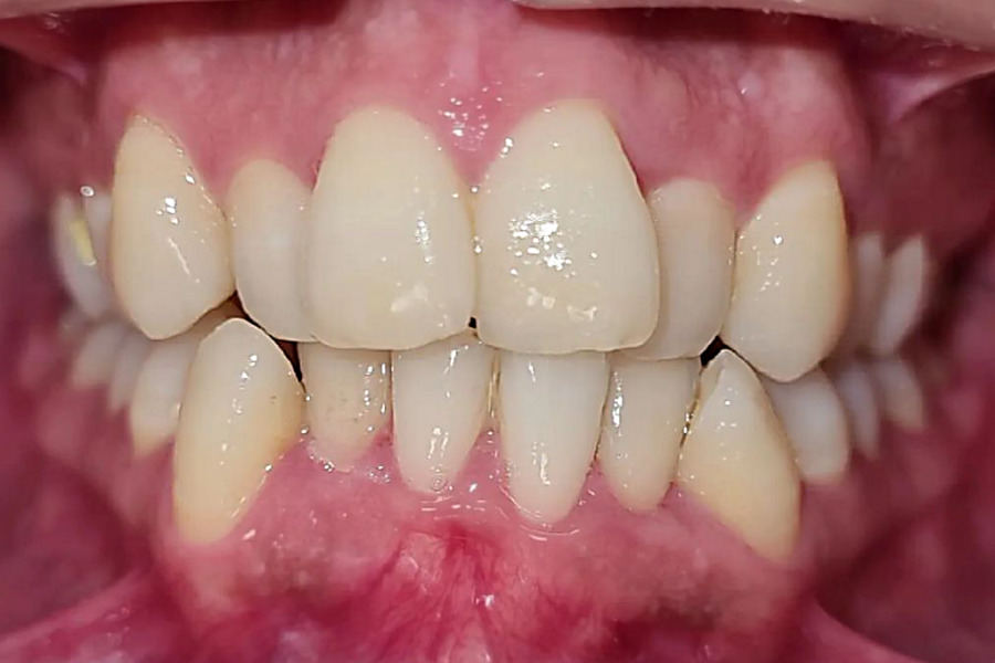 Crowding of teeth is it necessary to correct? How to fix crowding of