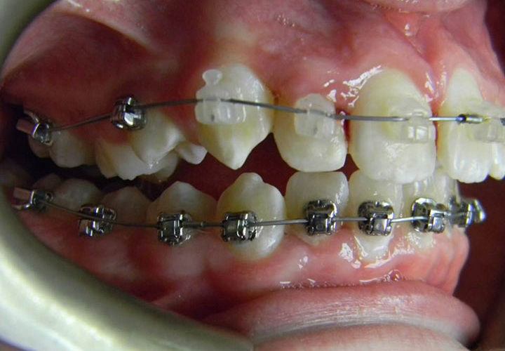 Crowding of teeth