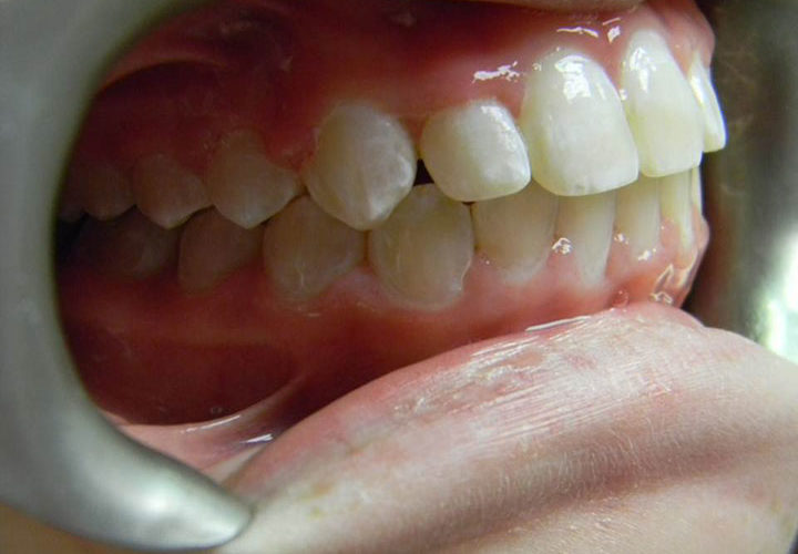 Crowding of teeth