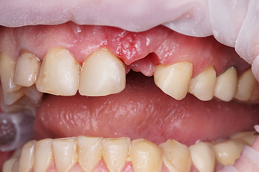 What you need to know about implantation?