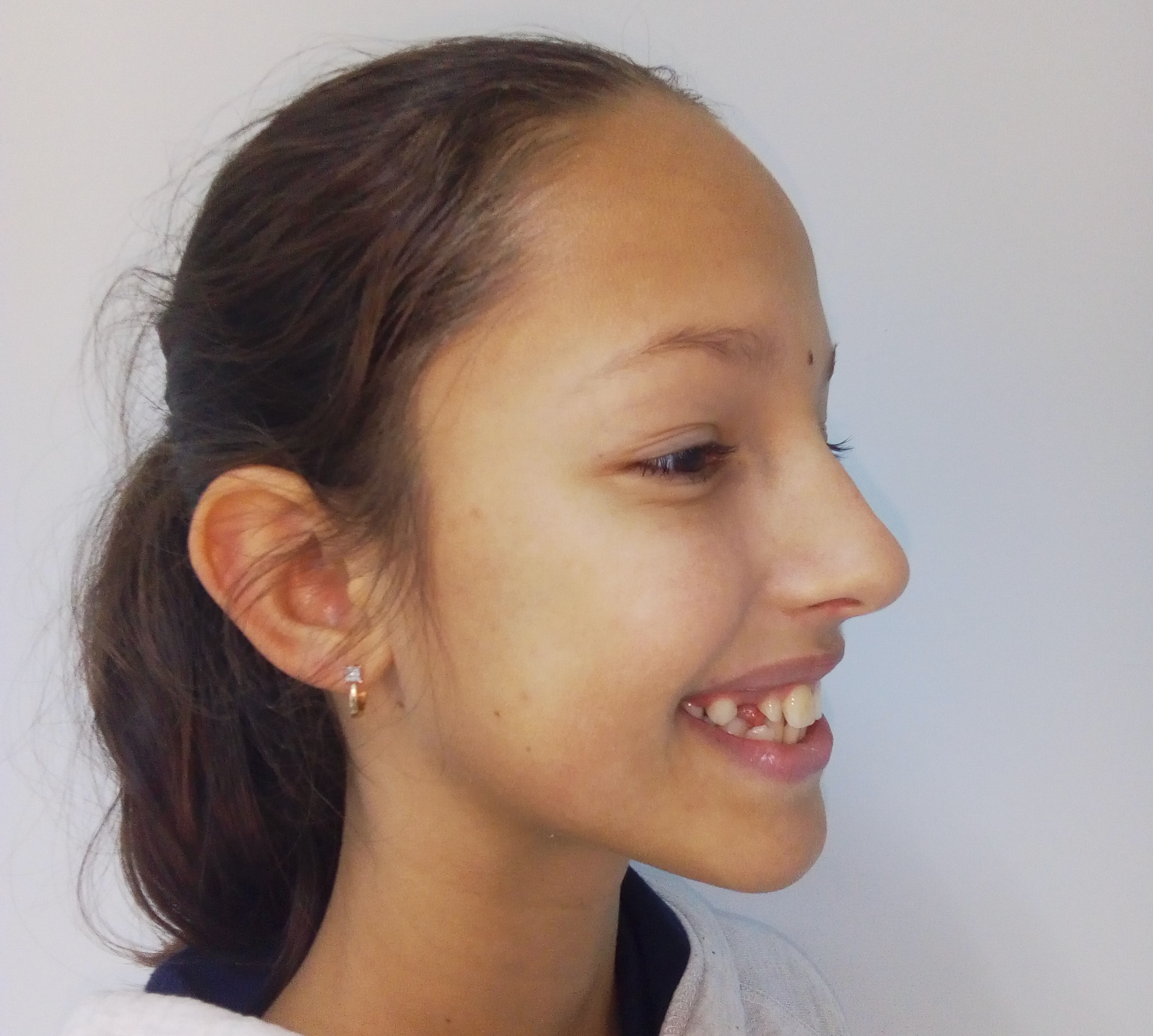 8 signs of impaired development of the facial skeleton in children