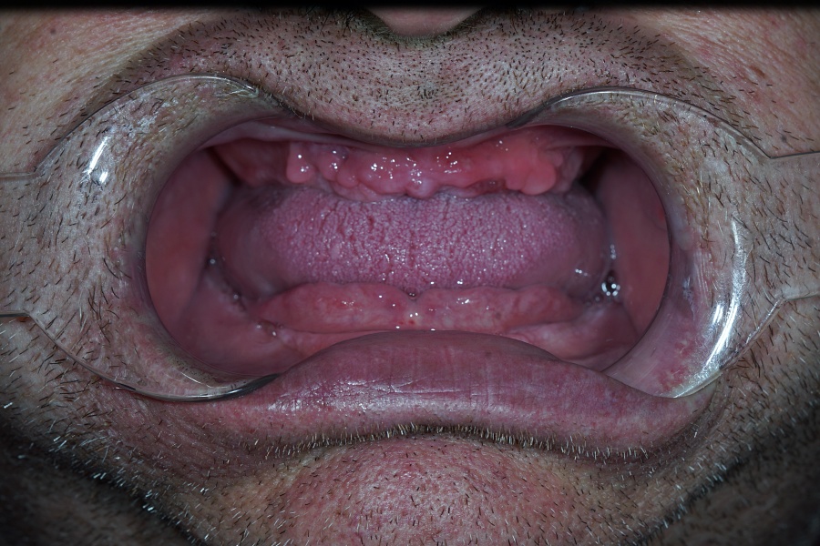 Имплантация при полном отсутствии зубов