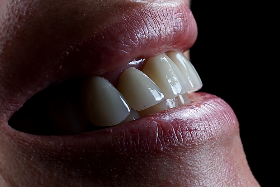 Імплантація передніх зубів