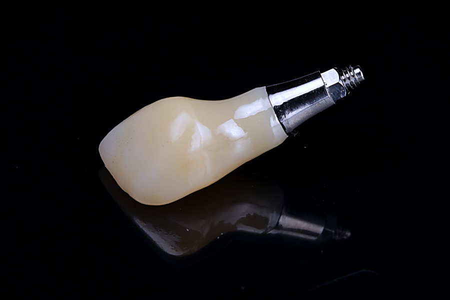 Одномоментная имплантация переднего зуба