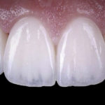 Tooth whitening