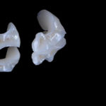 Veneers and lumineers installation