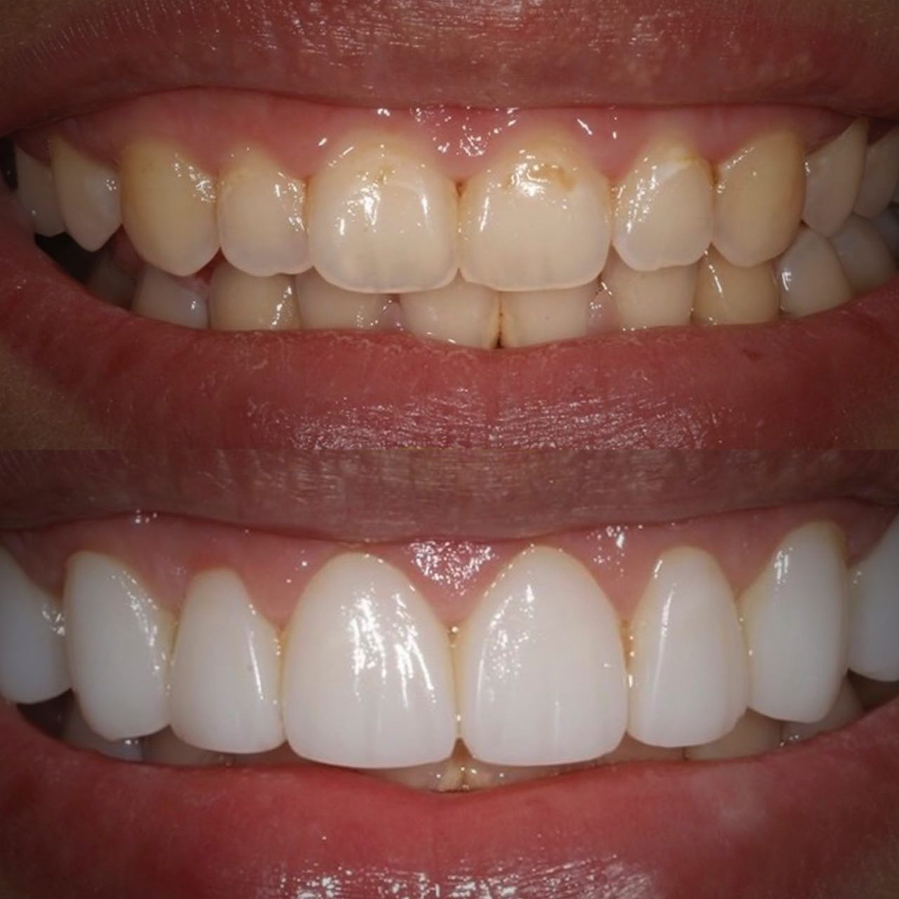 Ceramic dental crowns on the frame of zirconium dioxide - Installation ...