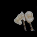 Художественная реставрация зубов