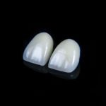 Veneers and lumineers installation