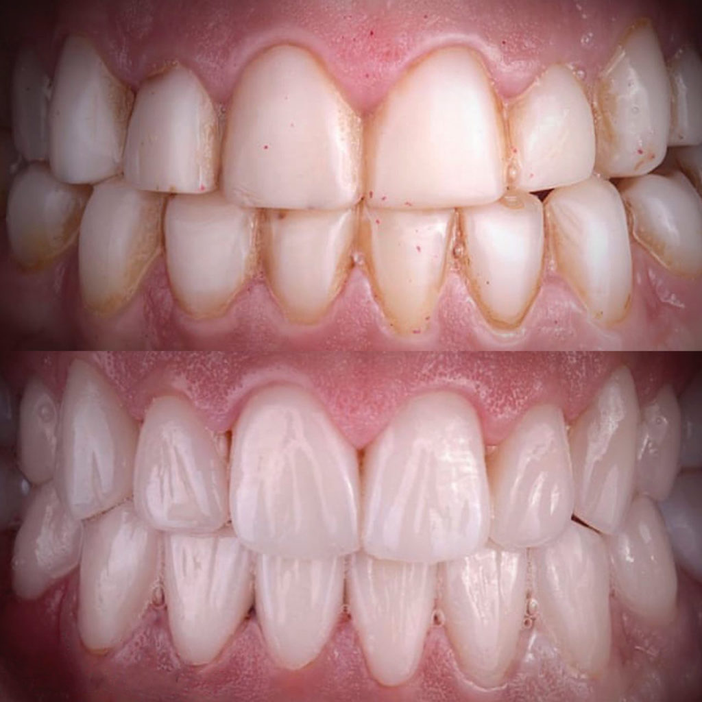Art restoration of teeth 🦷 Prices | iStomatolog dentistry, Kyiv