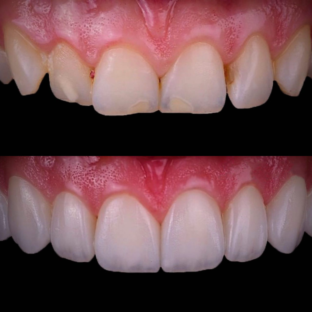 Art restoration of teeth 🦷 Prices | iStomatolog dentistry, Kyiv