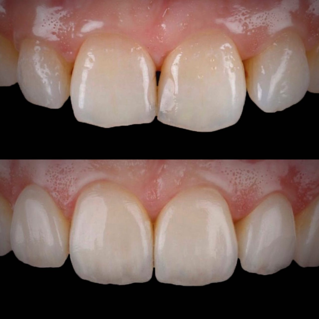 Art restoration of teeth 🦷 Prices | iStomatolog dentistry, Kyiv