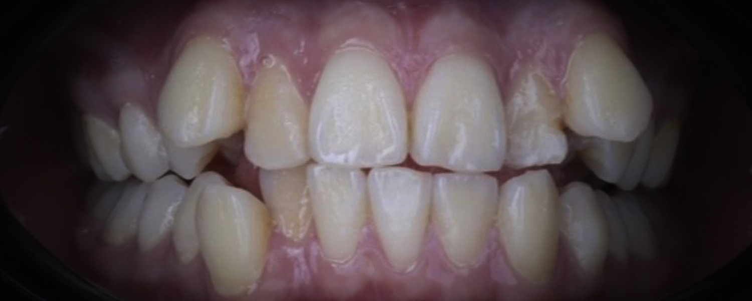 Приклади робіт виправлення прикусу