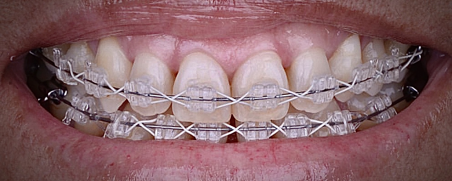 Приклади робіт виправлення прикусу