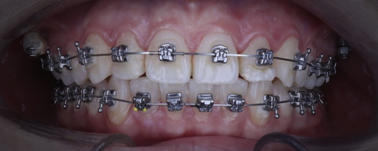 Приклади робіт виправлення прикусу