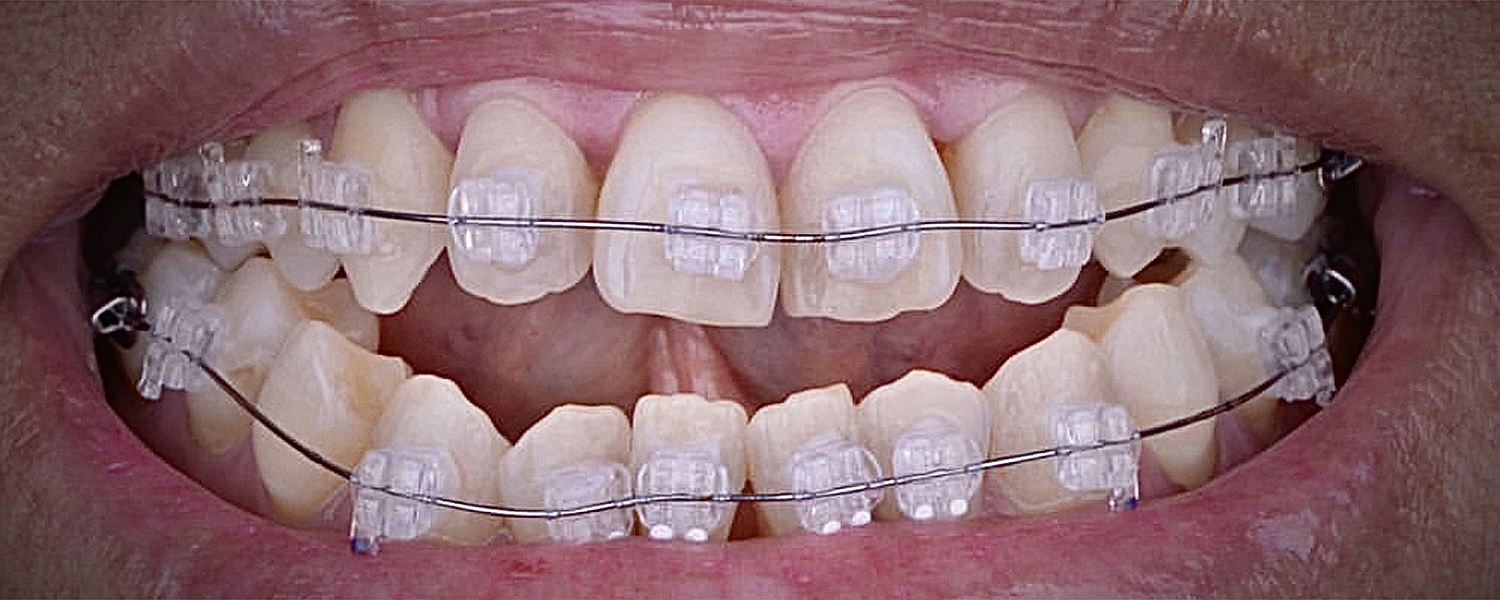 Приклади робіт виправлення прикусу