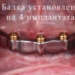 Протезирование при отсутствии всех зубов