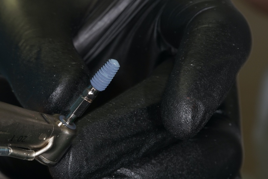 Как правильно подготовиться к имплантации зубов?