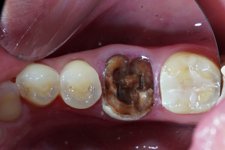 Одномоментна імплантація зубів в Києві