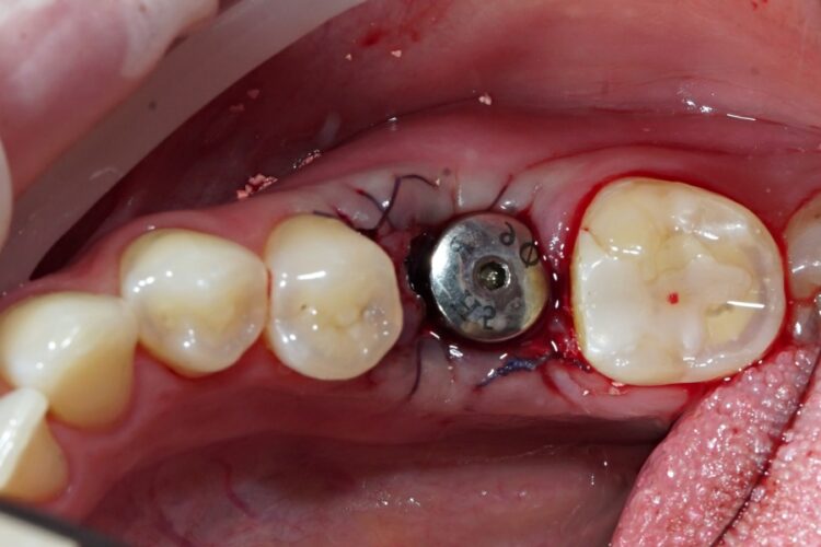 Одномоментна імплантація зубів в Києві