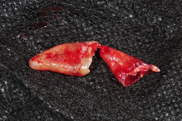 Одномоментна імплантація зубів в Києві