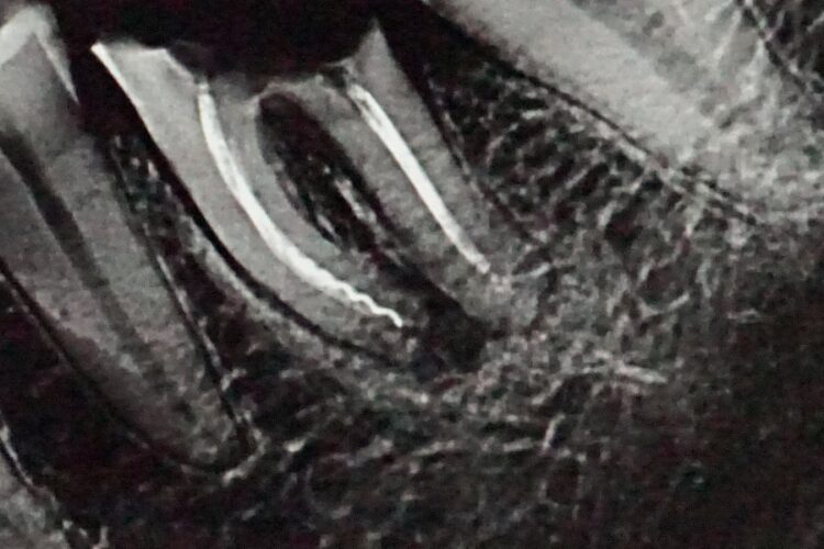 Одномоментна імплантація зубів в Києві