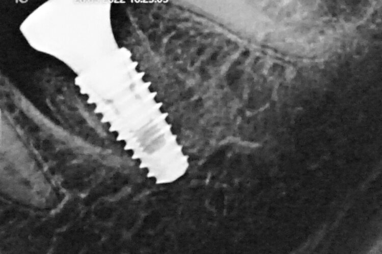 Одномоментна імплантація зубів в Києві