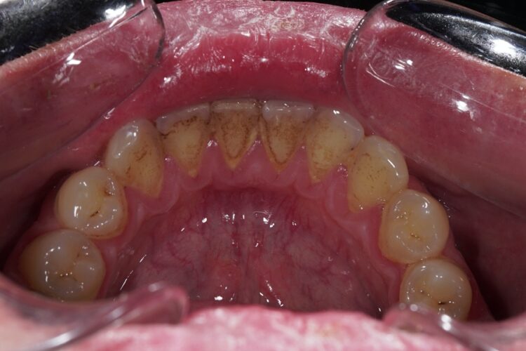 Professional teeth cleaning