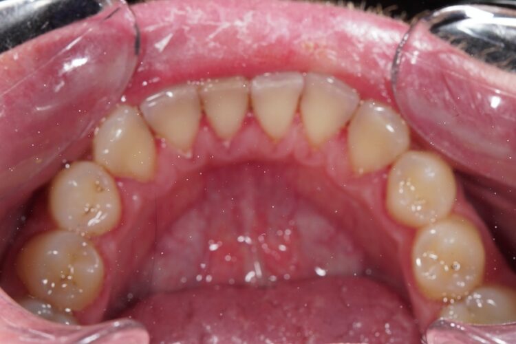 Professional teeth cleaning