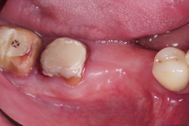 Двухэтапная имплантация зубов