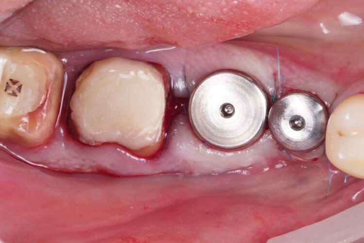 Двухэтапная имплантация зубов