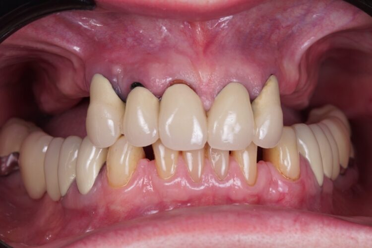 Протезирование при отсутствии всех зубов