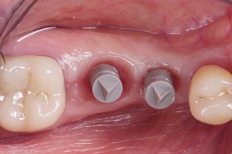 Двухэтапная имплантация зубов