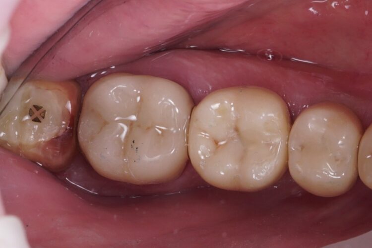 Двухэтапная имплантация зубов