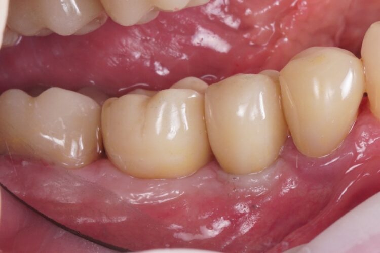 Двухэтапная имплантация зубов