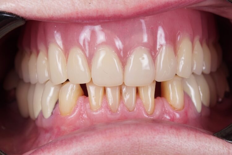 Протезирование при отсутствии всех зубов