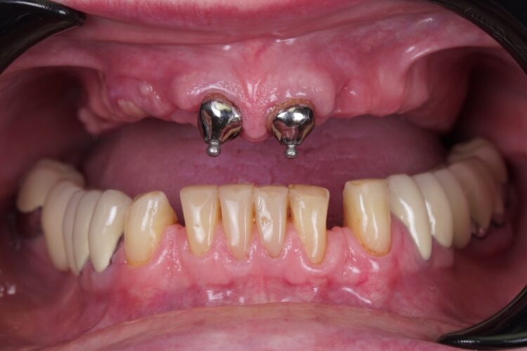 Съемные зубные протезы