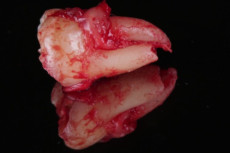 Атипичное удаление зубов