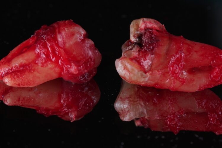 Атипичное удаление зубов