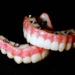 Протезирование при отсутствии всех зубов